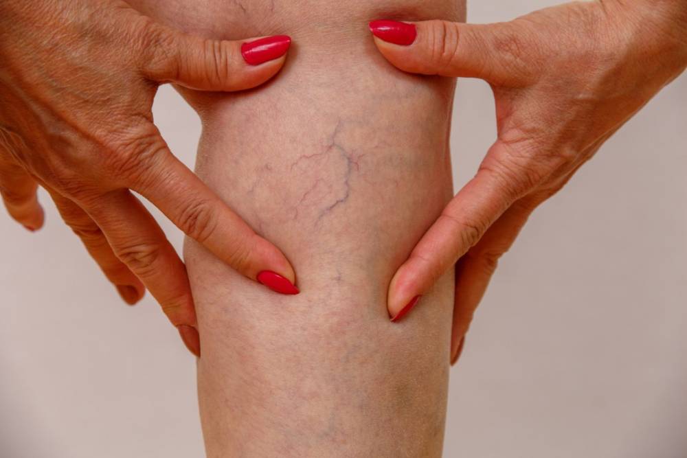 Varices à Cholet