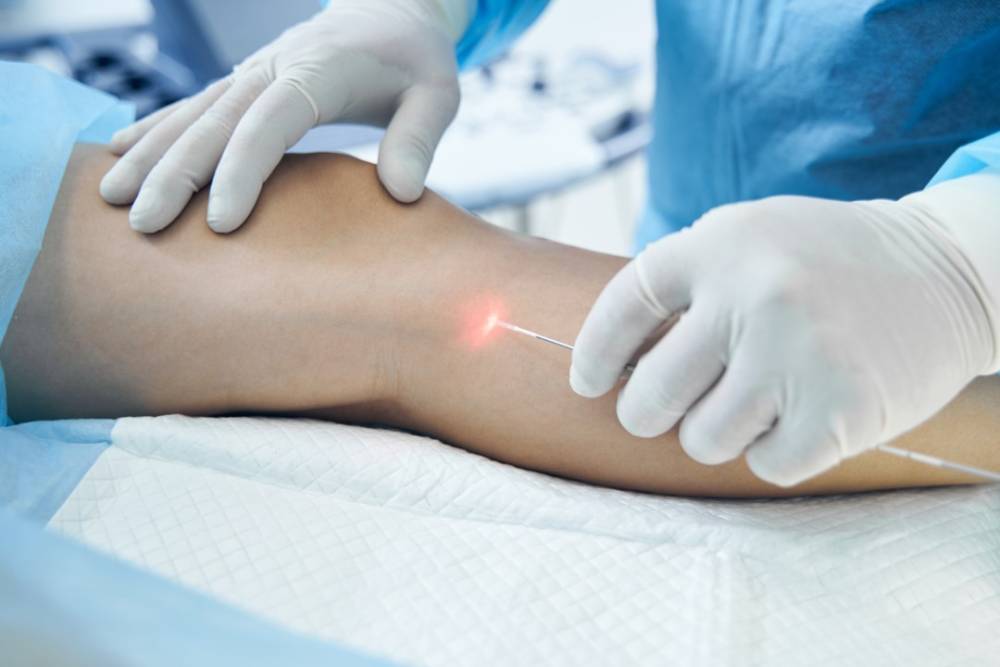 Laser endo veineux à Cholet